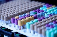 Nederland test eindelijk een screening voor prostaatkanker